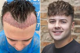 Comprehensive Hair Transplant Turkey Package: What to Expect